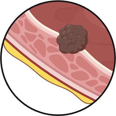 Urothelial Carcinoma