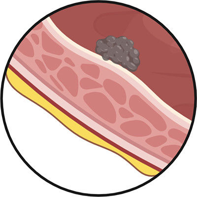 Small Cell Carcinoma