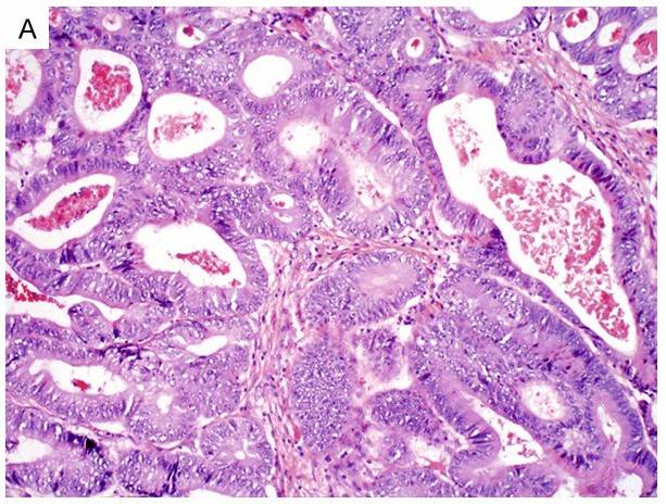 Fig.1 Enteric-type bladder adenocarcinoma. (Dadhania, V., et al., 2015)