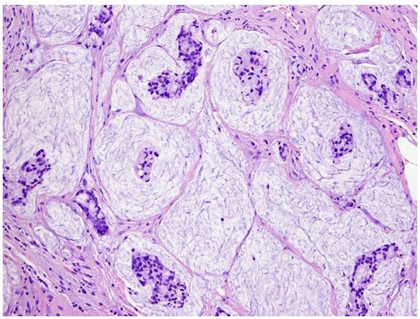 Fig.2 Mucinous-type bladder adenocarcinoma. (Dadhania, V., et al., 2015)