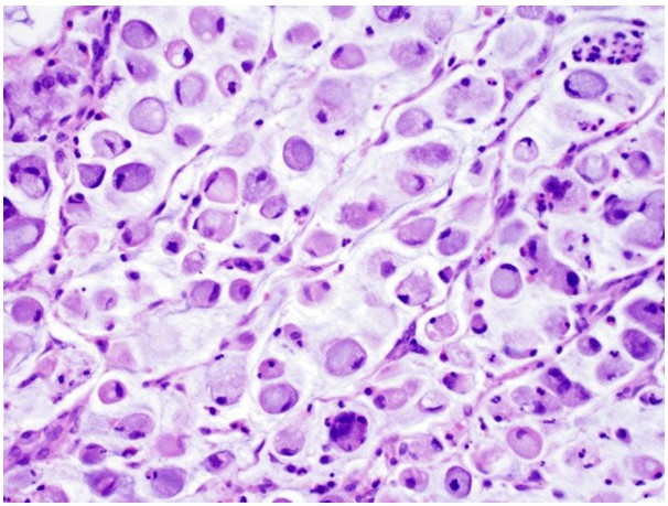 Fig.3 Signet ring cell-type bladder adenocarcinoma. (Dadhania, V., et al., 2015)