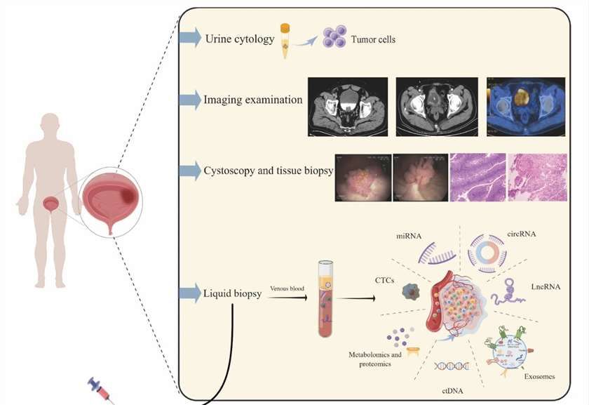 Fig.1 Overview of clinical examination methods for bladder cancer and laboratory analytical techniques for liquid biopsies.