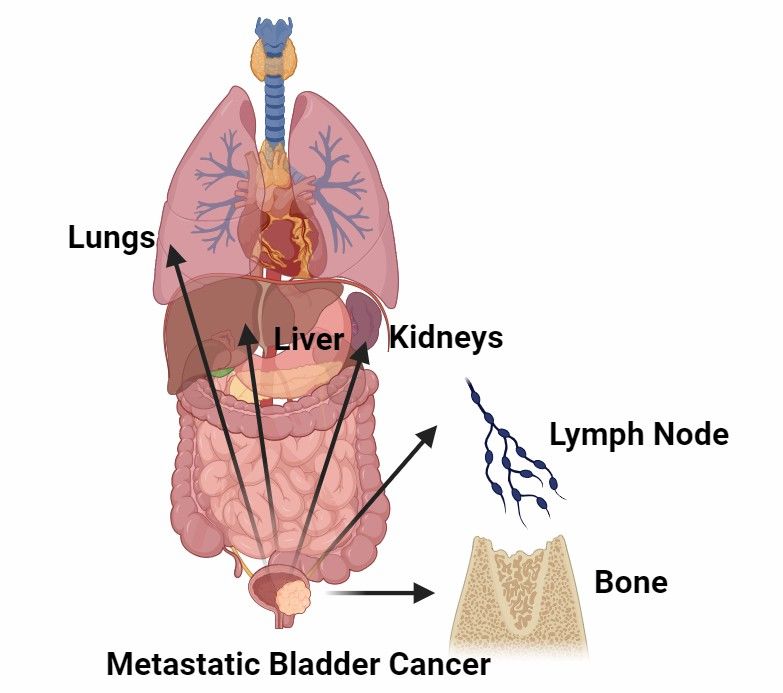 Fig 1. Metastatic Bladder Cancer.